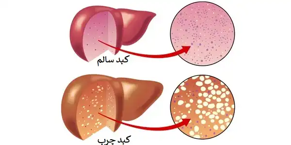 علایم کبد چرب غیر الکلی