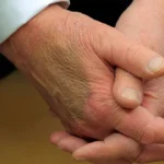 بیماری دونالد ترامپ چیست؟ - تورم مچ پا و کبودی دست ترامپ