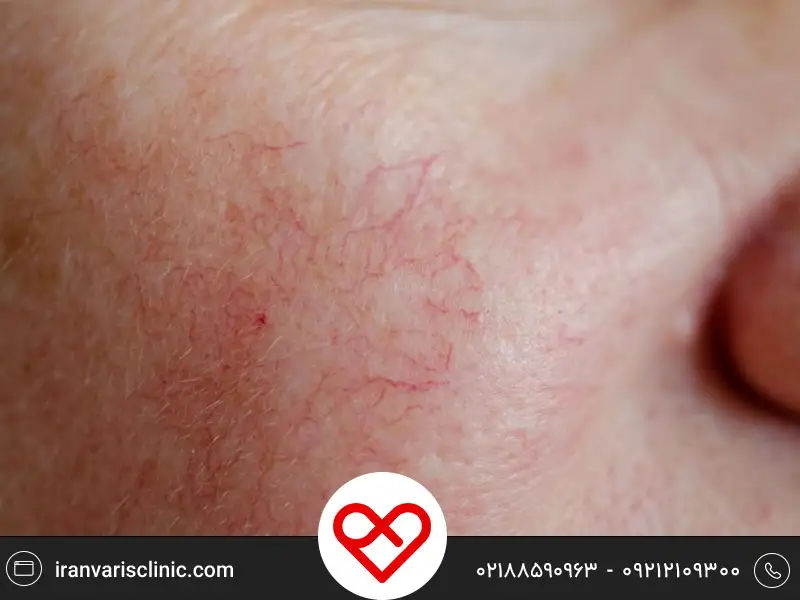 درمان واریس صورت بدون جراحی | روشهای مؤثر، مزایا و نکات مهم قبل از درمان